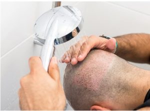 شستشوی مو بعد از کاشت مو
