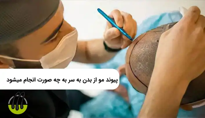 پیوند مو از بدن به سر