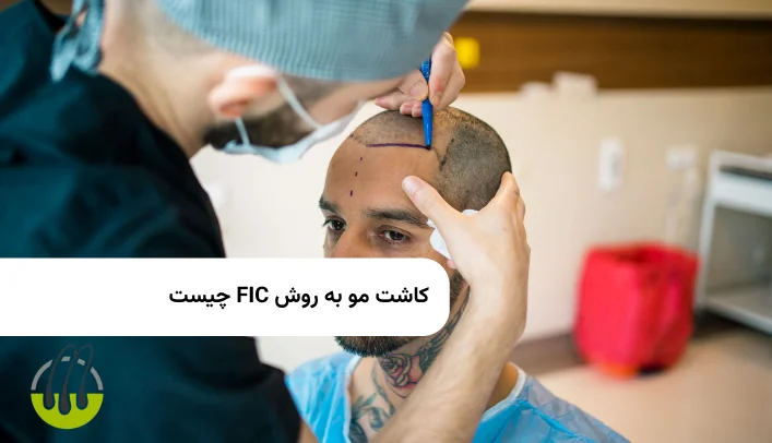 کاشت مو به روش FIC چیست + مزایا معایب
