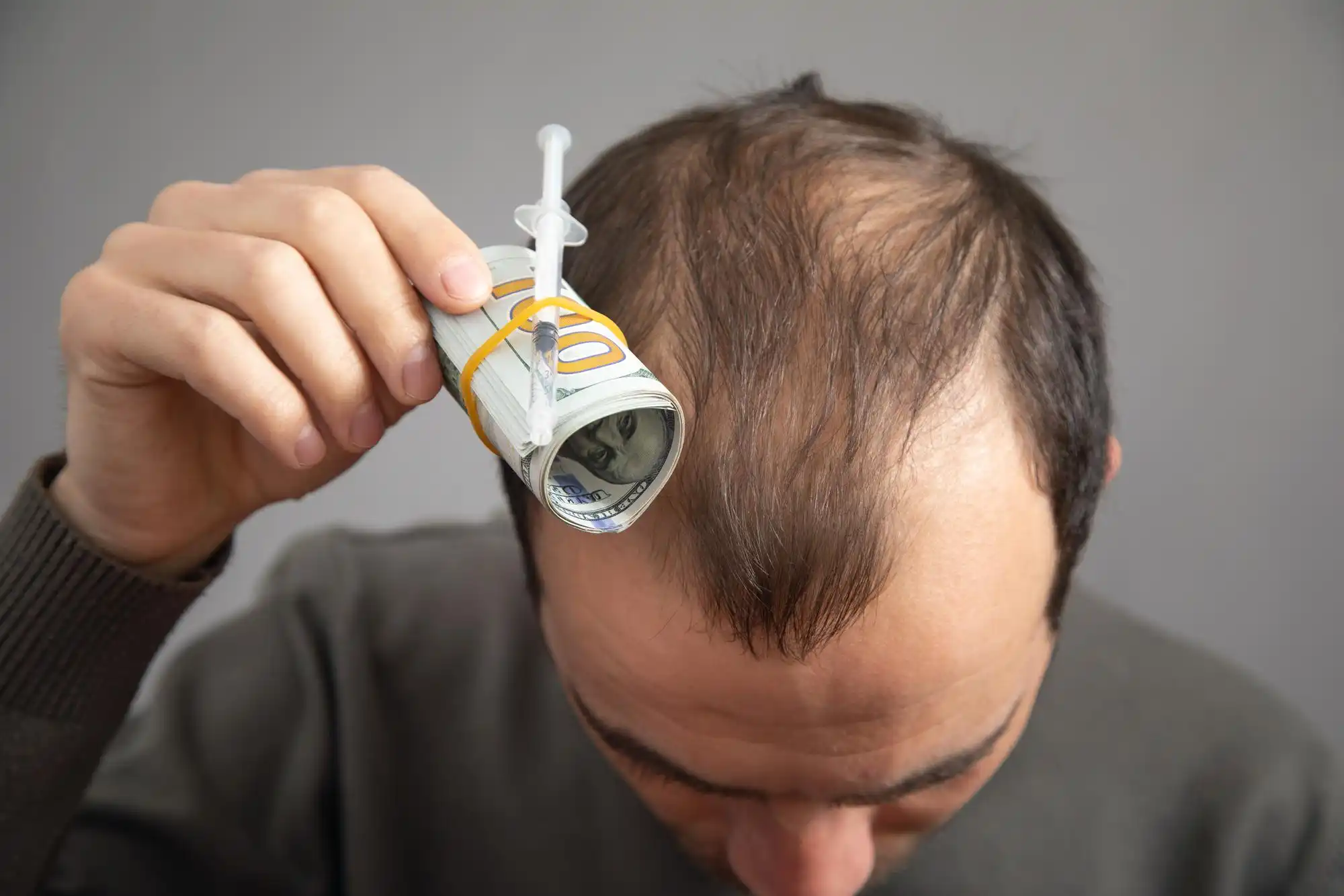 هزینه کاشت مو در کلینیک مهرسام